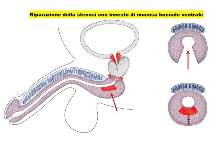Stenosi uretrale - Fig. 3