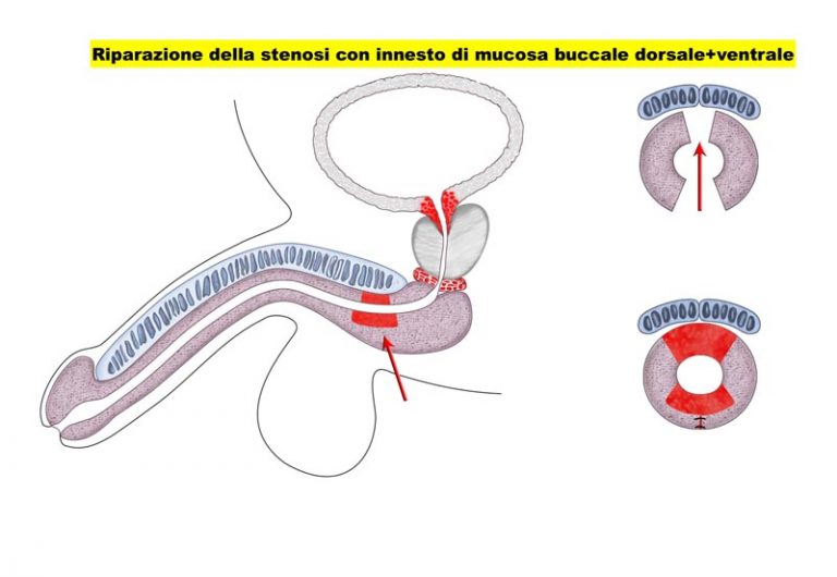 Stenosi uretrale - Fig. 4