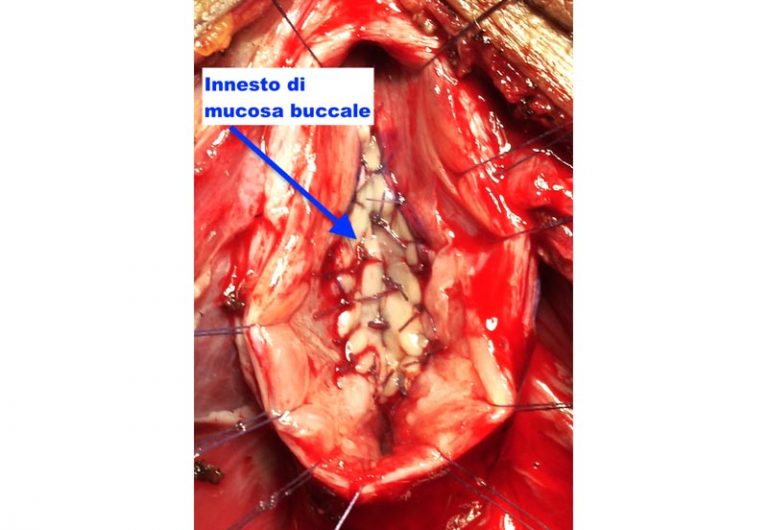 Stenosi uretrale - Fig. 5