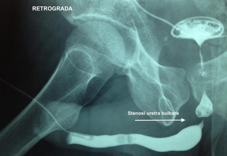 Stenosi uretrale - Fig. 6