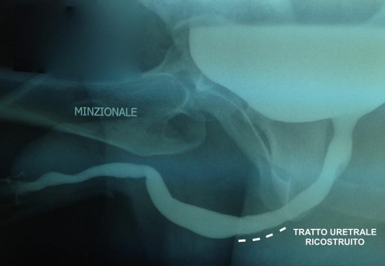 Stenosi uretrale - Fig. 7