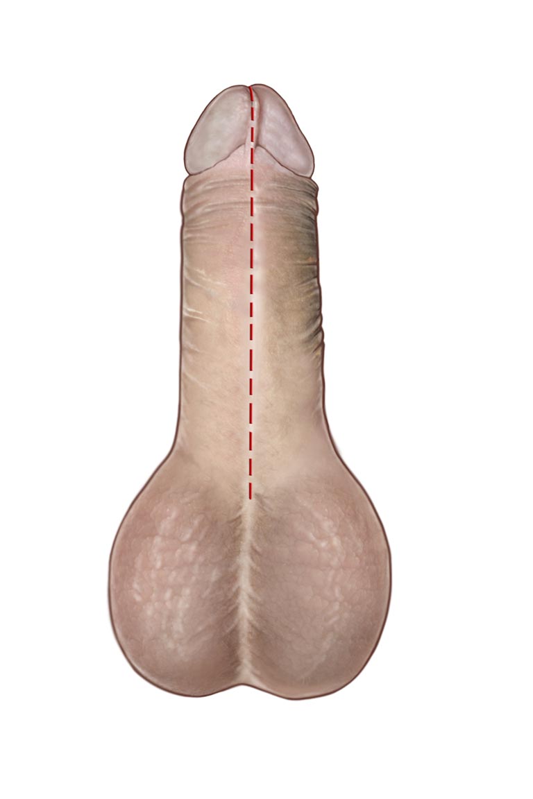 Stenosi uretrale - Fig. 8