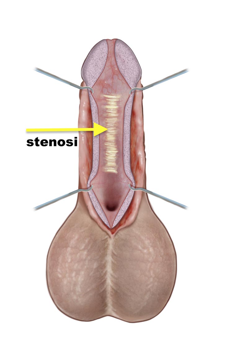 Stenosi uretrale - Fig. 9