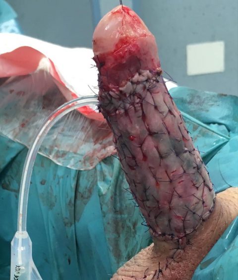 Ricostruzione del pene - Fig. 7